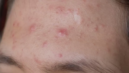 Facial Pore Cleaner Machine