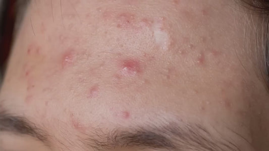 Facial Pore Cleaner Machine