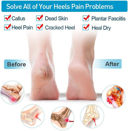 Cracked Heel Repair Sleeves